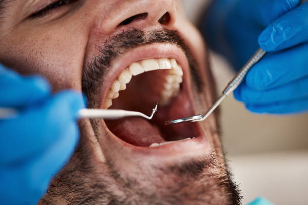 Best Emergency Dental Care for Broken or Chipped Teeth in Croom, MD